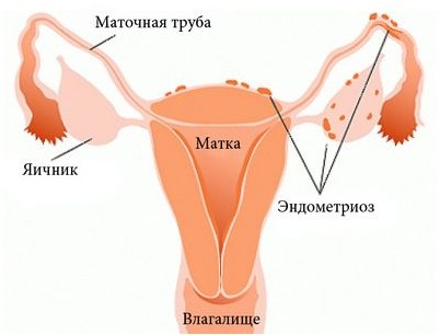 эндометриоза эндометриоза