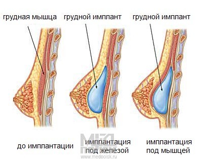 имплантаты