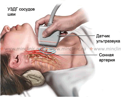 инсульт